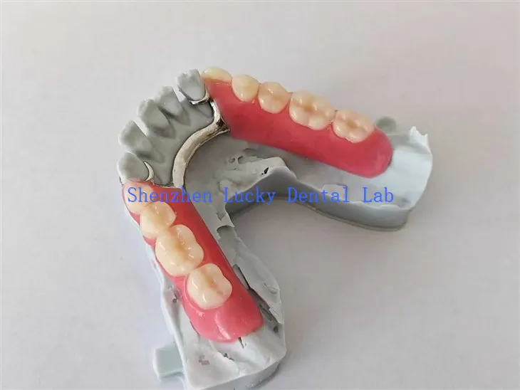 طباعة ثلاثية الأبعاد طباعة الأسنان الأكريليك الجزئية مع إطار المعادن حاول في مختبر الأسنان
