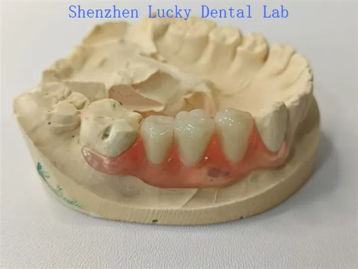 جمالية الأسنان زعنفة فالاست