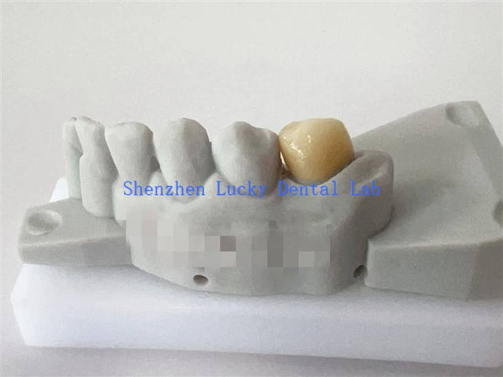 الصين مخصصة مصنع التاج Zirconia Zirconia
