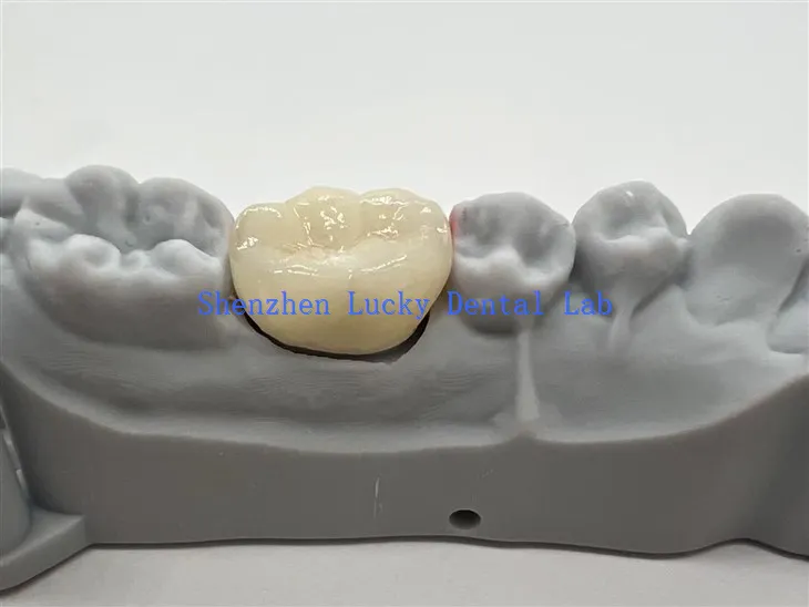 الصين طب الأسنان الكامل محيط Zirconia Crown Factory