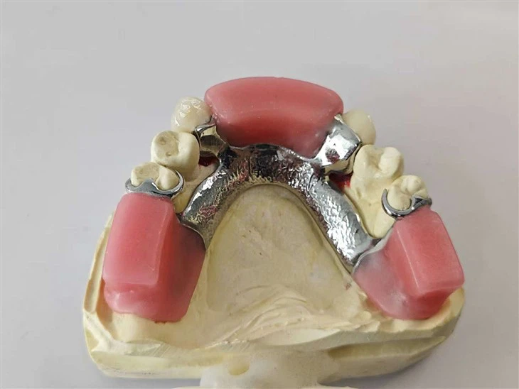 ارتباط دقة الأسنان من قناة الترباس مع إطار معدني وكتلة لدغة