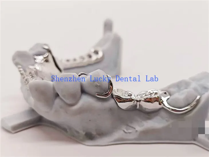 إطار المعادن مع تصميم الأسنان المدعومة من السبائك