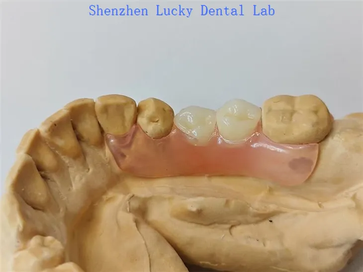 طب الأسنان المرن الجزئي مع مصنعو قفل فالس