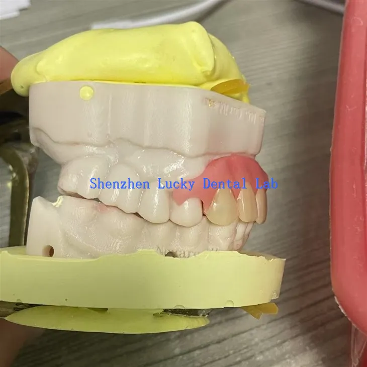 جرب أسنان مرن جزئي مريح في مختبر الأسنان