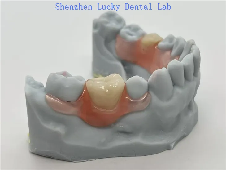 partials Valplast® مع مشبك مرن